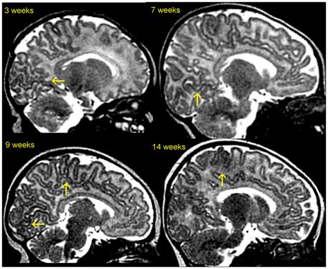 Infant Brain Maturation Across Age In T2w Mri These Sagittal Slices