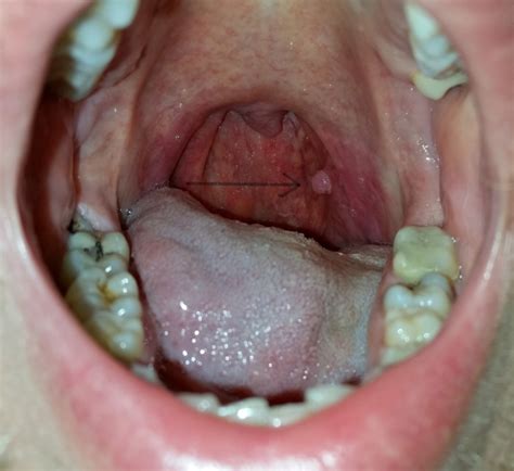 Throat Cancer | Introduction, Types, Symptoms & Treatment