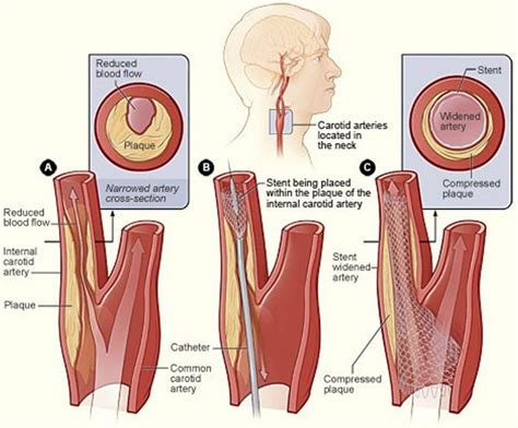 Carotid Artery Disease Stenosis Carotid Artery Dissection