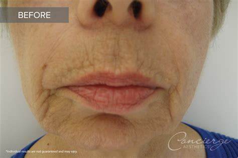 Before and After - Juvederm | Concierge Aesthetics, Irvine ...