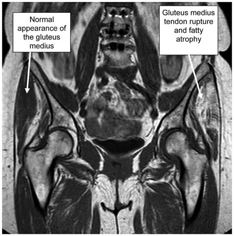 Hip Abductor Damage On Mri Shown Is The Coronal T1weighted Mr Image At