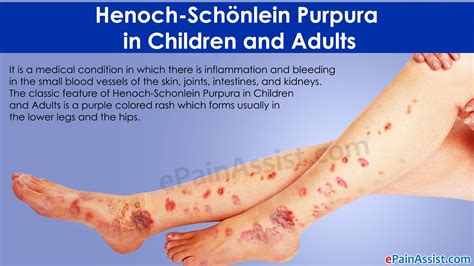 Henoch Schonlein Purpura In Children And Adults Read