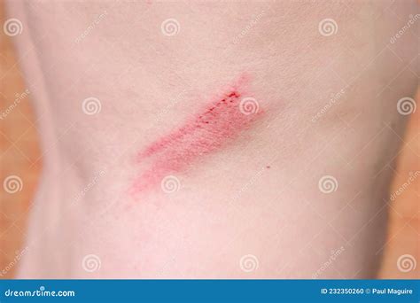 Grazed Skin Abrasion On A Man S Back Uk Stock Photo Image Of