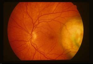 Exudative Retinal Detachment Eyewiki