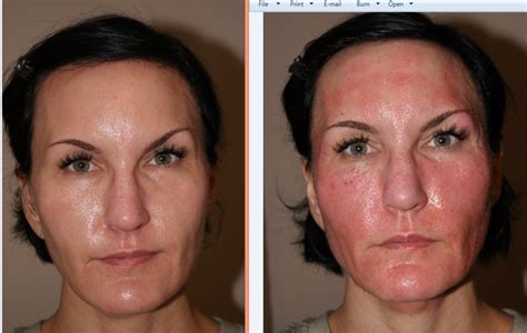 Fractora Rf Ablative Skin Resurfacing And Skin Tightening Of The Face