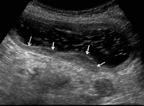 Gastric Carcinomas Of Diffuse Infiltrative Form In The Posterior Wall