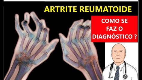 Aprender Sobre Imagem Artrite Reumatoide Sintomas Fotos Br