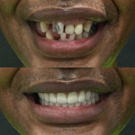 All On 4 Teeth In A Day — Memphis Dentures And Implants