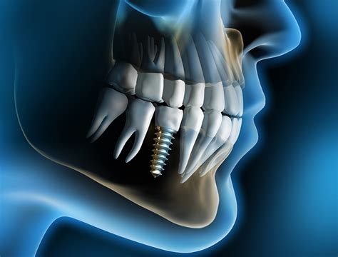 Cấy ghép implant sau bao lâu sẽ lành vết thương Niềng răng giá rẻ