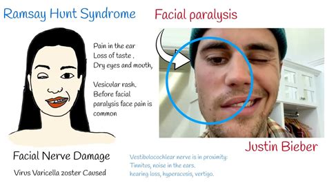 Ramsay Hunt Syndrome Justin Bieber Reveals Facial Paralysis Youtube