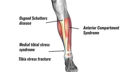 Lump On Lower Leg After Exercise Online Degrees