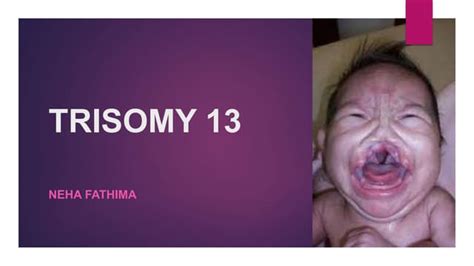 Trisomy 13 Ppt