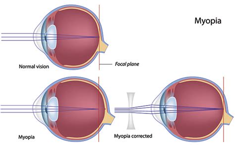 In fact, headaches are one of the most common symptoms of uncorrected nearsightedness. Myopia(Nearsightedness):Symptoms,Causes & Treatment » How ...
