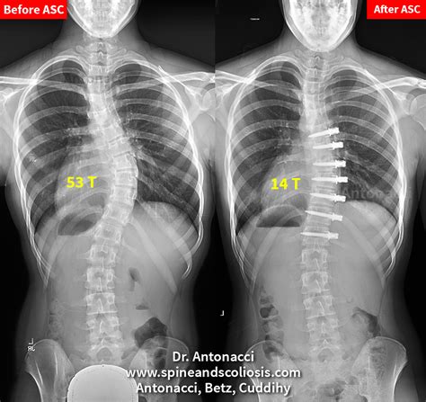 Before And After Scoliosis Surgery Case Studies