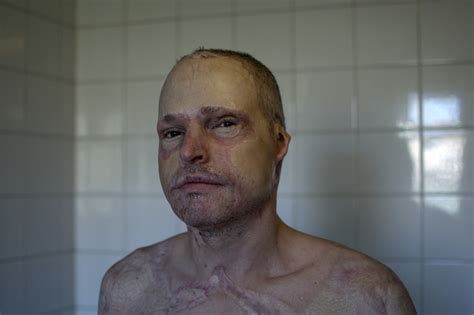 Photographer Pictures Of Scars People Received From Near Death Experiences Metro News