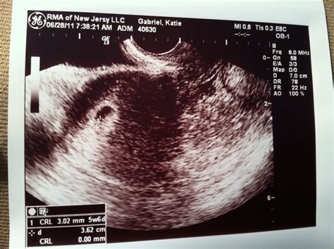 In the case of a 6 weeks pregnant ultrasound, your doctor may be able to detect a fetal heartbeat or see a fetal pole, or even two gestational sacs if you're having twins. Dear Hope: Ultrasound Pictures