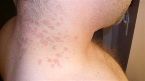 Brown Spots On Neck Pictures Photos