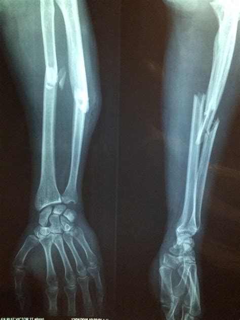 24 Hour Emergency Fracture Treatment In Harris County Tx