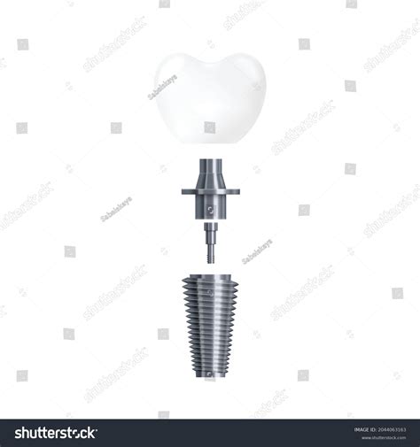 3d Ilustración Realista Del Implante Dental Vector De Stock Libre De