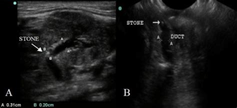 A Ultrasound Of Submandibular Gland Depicting Intraduc Open I
