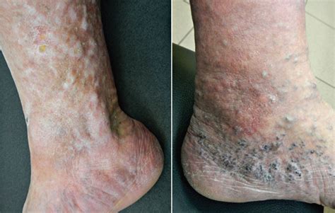 Dermatitis Feet Pictures Symptoms And Pictures