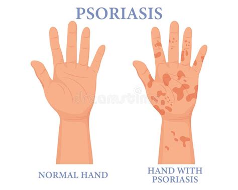 Psoriasis Healthy And Unhealthy Hand Dermatology The Concept Of