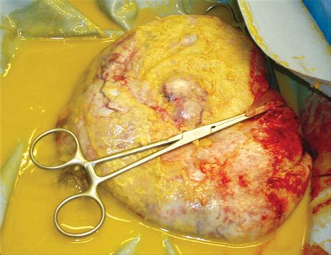 Squamous Cell Carcinoma Arising In A Mature Cystic Teratoma Of The My