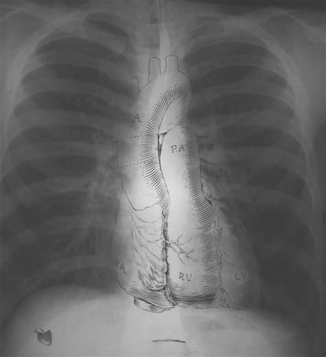 Normal Chest X Ray Litfl Medical Blog Labelled Radiology