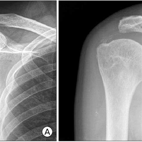 A Initial Plain X Ray Of Calcific Tendinitis Patient B After Hot Sex Picture