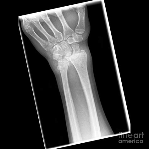 Dislocated Wrist X Ray Photograph By Science Photo Library