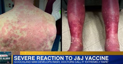 Johnson & johnson says it's going to delay the rollout of its vaccine in europe and is reviewing the blood clot cases. Photos: Man Has Rare, Horrifying Reaction to Johnson ...