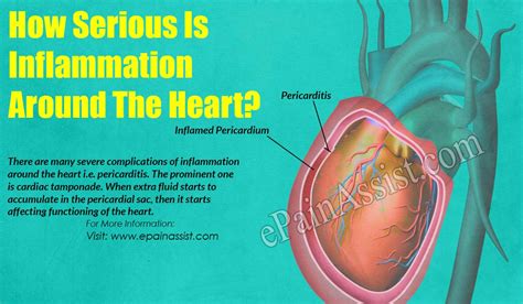 How Serious Is Inflammation Around The Heart