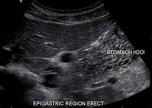 Sonographic Demonstration Of Stomach Pathology Reviewing The Cases