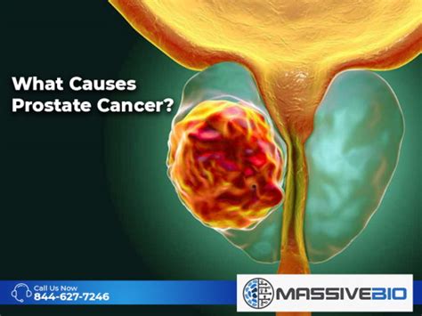 What Causes Prostate Cancer Prostate Cancer Risk Factors