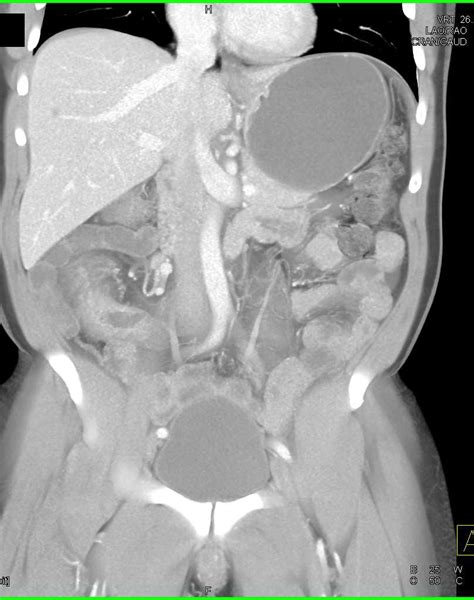 Crohns Disease Involves The Terminal Ileum Small Bowel Case Studies