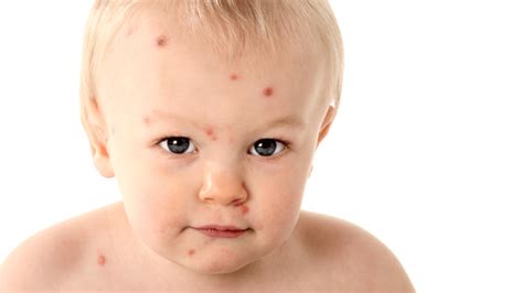 Chicken Pox Treatments Whats The Best One