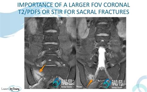 How To Find A Sacral Fracture On A Lumbar Mri Radedasia