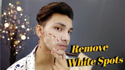 Remove White Spots In Just 7 Days How To Get Rid Of White Spots