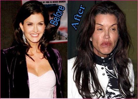 Top 25 Celebrities Before And After Plastic Surgery And Nose Jobs Celebrit Bad Celebrity