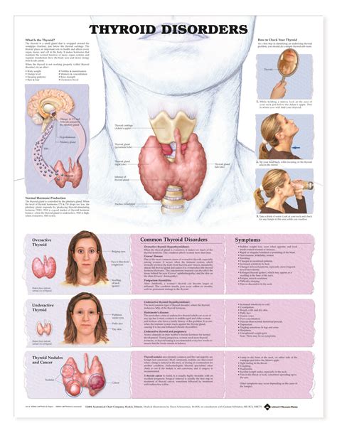 Thyroid Disorders Anatomical Chart Thyroid Disorders Thyroid Nurse