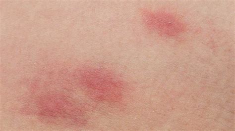Bites And Stings Pictures Causes And Symptoms