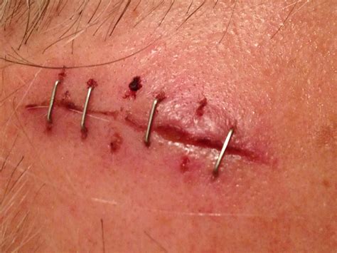 Laceration, Staples, Removal - MyTractorForum.com - The Friendliest ...