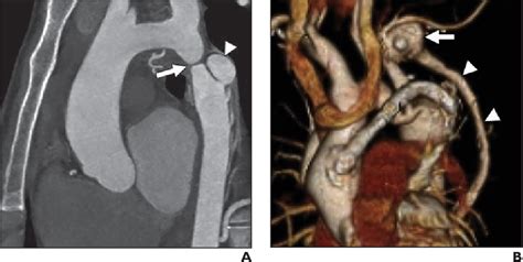 Figure 14—29 From Ct And Mri Of Aortic Coarctation Pre And