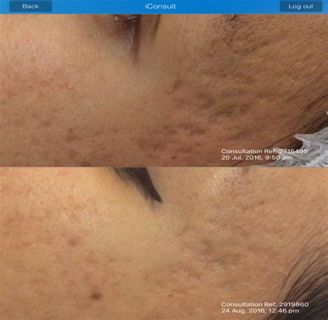 Acne Treatments Gold Coast Oo La La Cosmetic And Laser Clinic