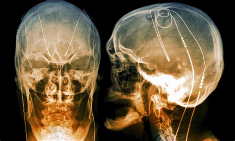 How Do Neural Implants Work Ieee Spectrum