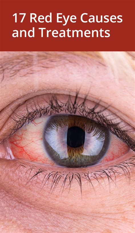 19 Causes And Treatments For Red Eyes Red Eyes Remedy Red Veins In