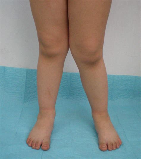 Albums 92 Pictures Knock Knee Surgery Before And After Photos