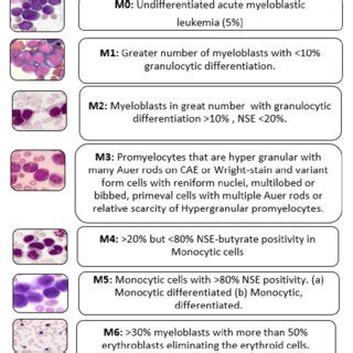PDF Insights Into Acute Myeloid Leukemia Critical Analysis On Its