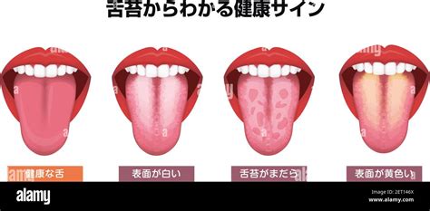 Tongues Health Sign Vector Illustration White Coated Tongue Stock