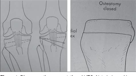 Figure 1 From High Tibial Closing Wedge Osteotomy For Medial